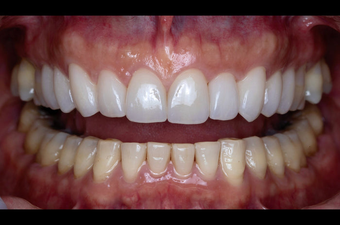 Esthetic Techniques with Anterior Crowns and Veneers