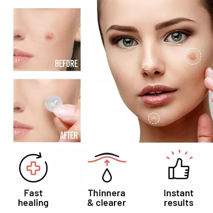 Hydrocolloid Acne Patches for Day & Night